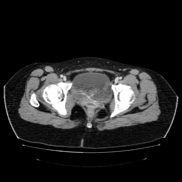 Ureteric Jets seen by greyscale ultrasound - Radiopaedia